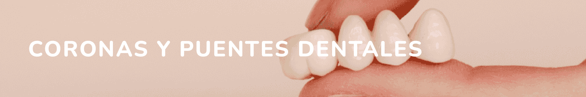 MENU CORONAS Y PUENTES DENTALES