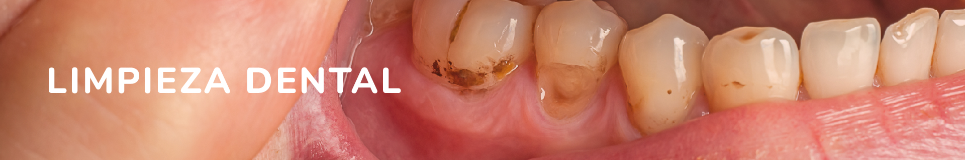 MENU LIMPIEZA DENTAL - SALUDENT
